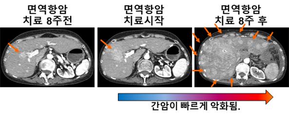 면역항암치료 후 간암의 급성진행현상 규명